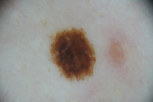 Lésion brun foncé cernée d'une couronne de globules bruns.