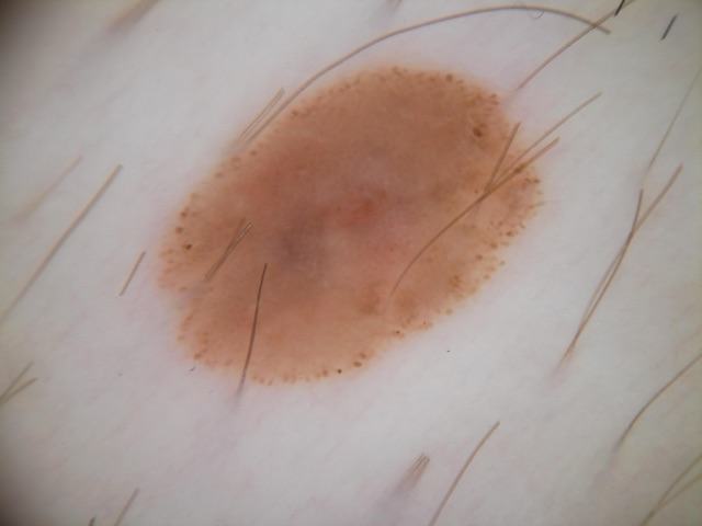 Couronne régulière de globules bruns sur tout le pourtour d'une lésion brune homogène.