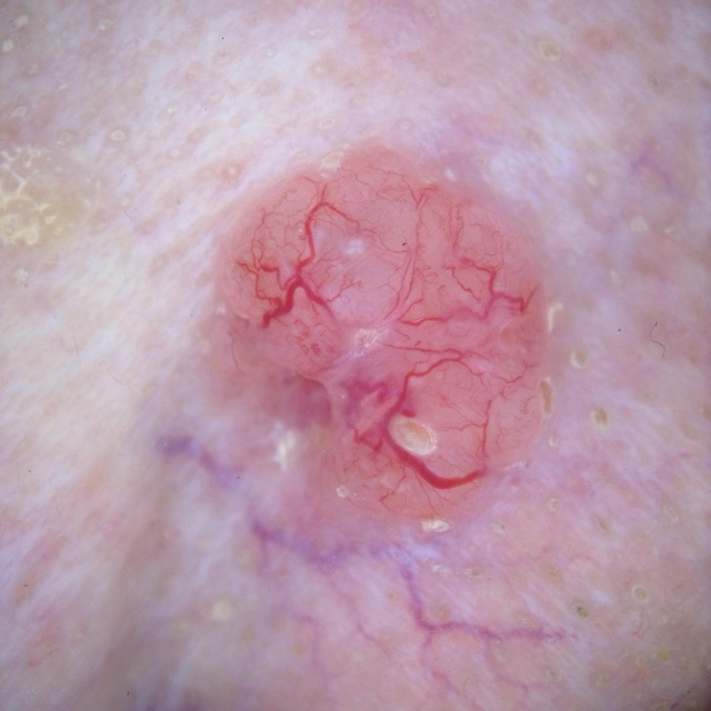 Nodule rose translucide parcouru de vaisseaux rouge vif ramifiés, de calibre décroissant.