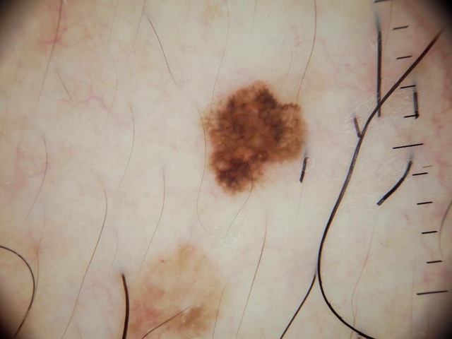 Petite macule brune bien limitée, plus foncée au centre, à pigmentation régulière.