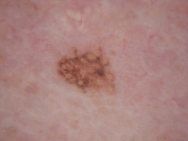Globules bruns ronds de taille voisine, groupés sur toute la lésion.