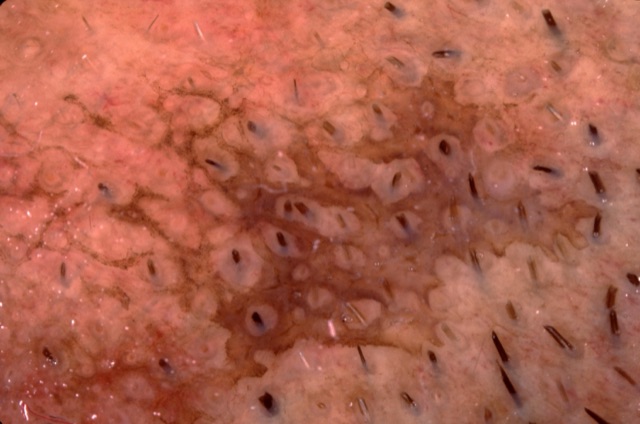 Pigment brun autour des orifices folliculaires (pseudo-réseau) ; un poil au centre de chaque follicule.