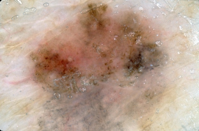 Granulations grises en nappe en bas, zones brunes et gris-noir, squames en surface.