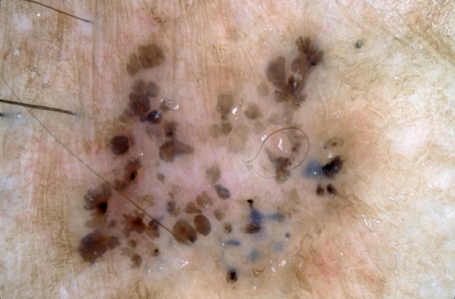 Mottes brunes multiples et globules gris-bleu dispersés en bas à droite, sans réseau.