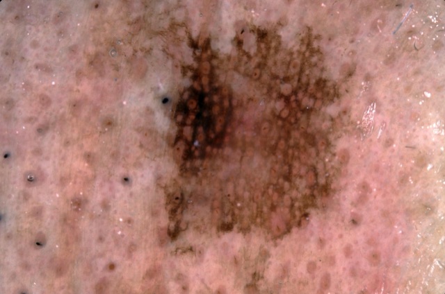 Plage brune trouée d'orifices folliculaires, plus foncée à gauche.