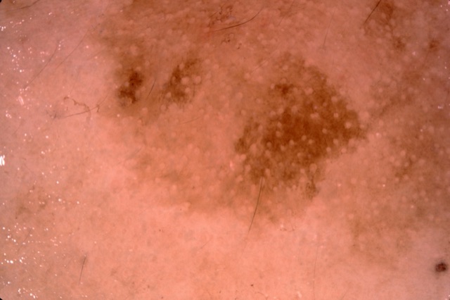 Nappe brune trouée de cercles clairs réguliers (orifices folliculaires) : pseudo-réseau du visage.