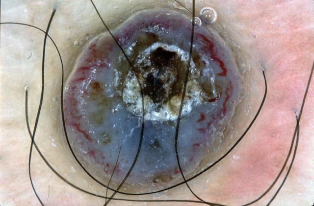 Nodule gris-bleu, ulcération croûteuse centrale, vaisseaux rouges sur le bord.