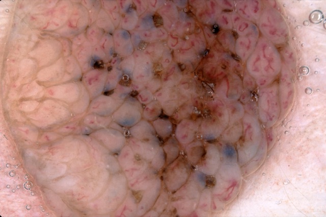 Lobules saillants, vaisseaux en virgule, globules bruns et gris-bleu dispersés au centre.