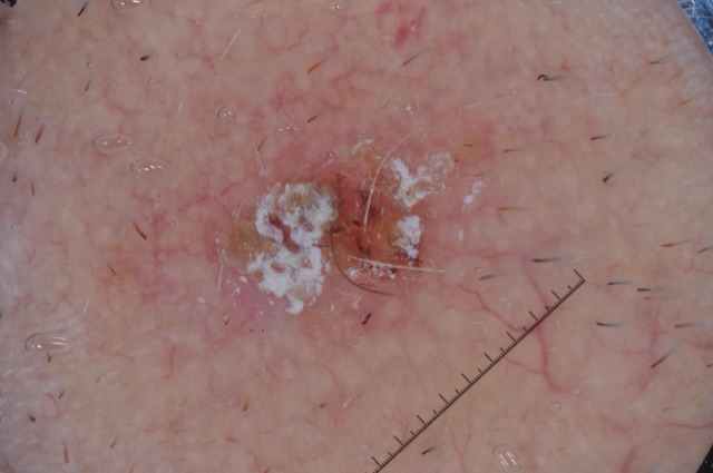 Squames blanches opaques au centre d'une zone rose parcourue de vaisseaux.