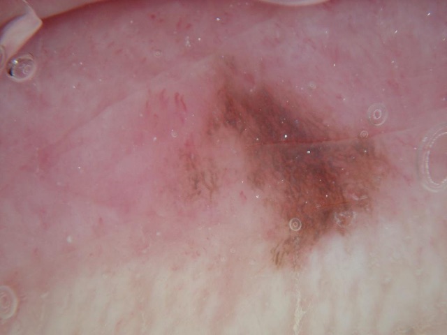 Macule brune à contours irréguliers sur une muqueuse rose, plus foncée au centre, avec de fines lignes brunes sur le bord gauche.