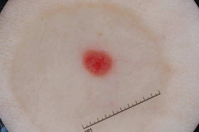 Petite papule rouge vif, ronde et bien limitée, semée de points rouge sombre, sans pigment brun.