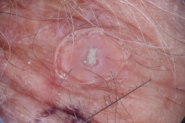 Masse de kératine blanche, opaque, au centre d'une papule rose.