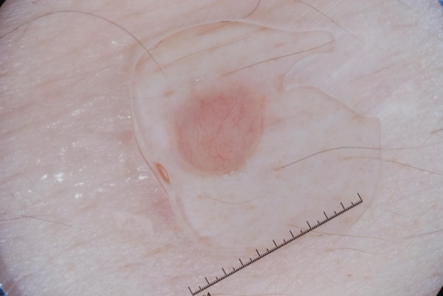 Papule ovale rose pâle, homogène, aux contours flous, avec de fins vaisseaux en surface.