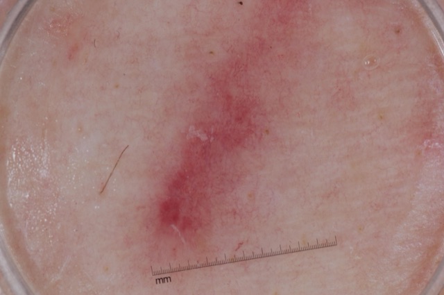 Bande linéaire rose-rouge, sans pigment, qui traverse le champ en diagonale.