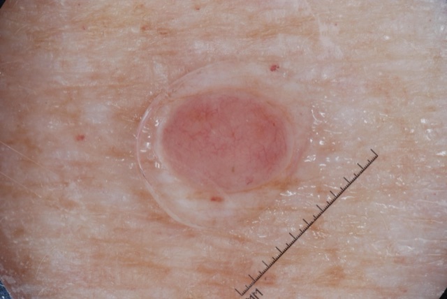 Papule ronde rose, homogène et bien limitée, parcourue de quelques fins vaisseaux, sans pigment.