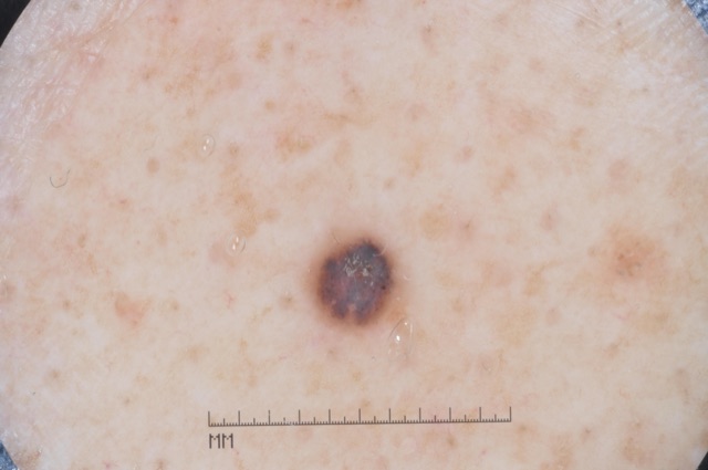 Petite papule ronde violacée à brun sombre, à bords nets, isolée sur une peau semée de taches brun clair.