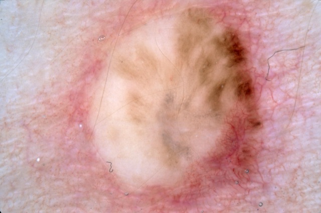 Zone blanche cicatricielle au centre, pigment brun en traînées et en mottes surtout à droite, érythème autour.