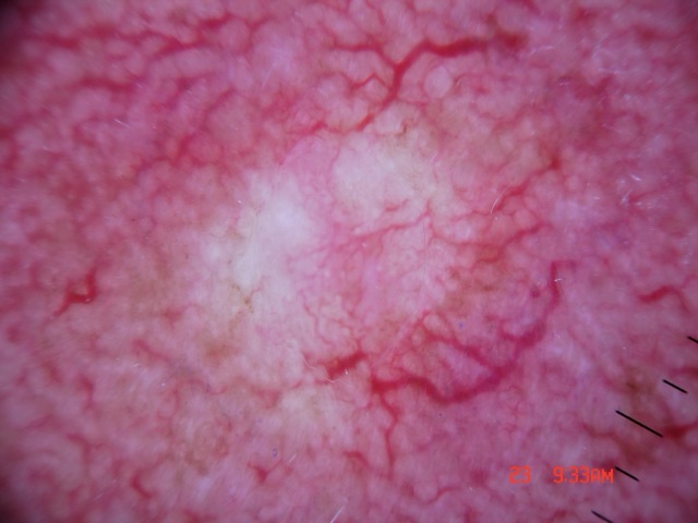 Vaisseaux arborisants rouge vif autour d'une plage centrale blanche.