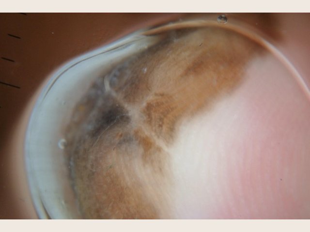 Sous le bord libre translucide de l'ongle (en haut à gauche), pigment brun avec une zone gris-bleu, étalé sur la peau de l'hyponychium et de la pulpe.