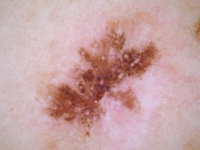 Pigment brun en traînées disposées en étoile sur un fond blanc-rosé, points bruns et gris au centre.
