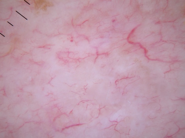 Fond blanc-rosé parcouru de vaisseaux fins ramifiés, sans pigment.