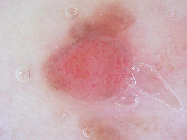 Lésion rose presque sans pigment (un peu de brun en haut), fins vaisseaux sur fond rouge.