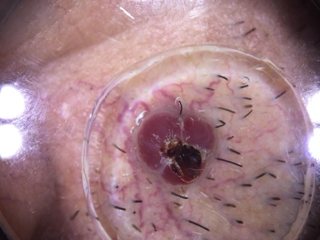 Nodule rouge homogène, sans vaisseau individualisable, couvert au centre d'une croûte brun-noir ; vaisseaux sinueux sur la peau voisine.