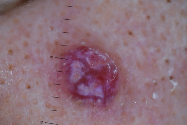 Nodule violacé, entre rouge et bleu, sans lacune nette, traversé de plages blanchâtres.