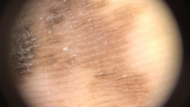 Pigment brun en larges bandes parallèles sur peau acrale, plage plus sombre à gauche.