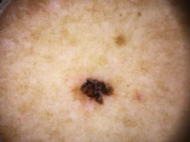 Petite lésion brun foncé à noire, irrégulière, sur une peau tachetée de lentigos.
