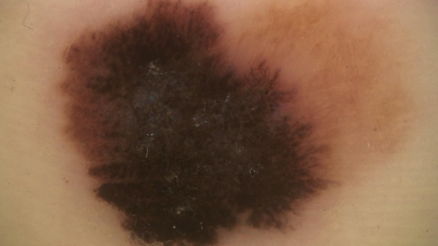 Nappe brun-noir asymétrique, plus sombre et grisée au centre, qui recouvre tout le relief cutané, bordée à droite d'une zone brun clair.