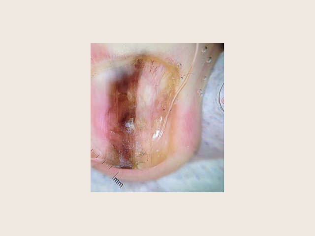 Ongle déformé, parcouru au centre d'une bande pigmentée brun clair à brun foncé, mêlée de gris, aux lignes inégales ; tablette blanchâtre et irrégulière vers le bas.