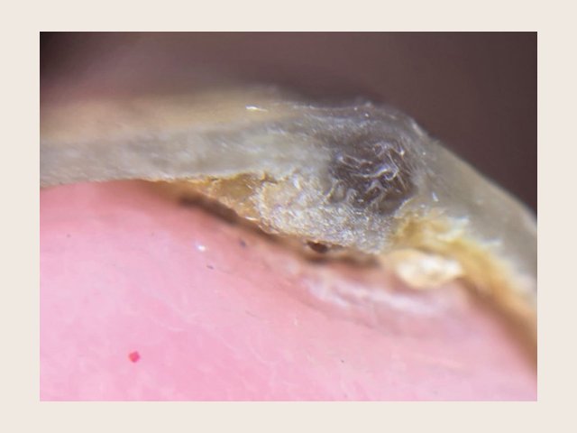 Vue du bord libre coupé : sous la tablette translucide, au centre, un amas corné jaunâtre soulève l'ongle, juste sous une zone pigmentée grise de la tablette.