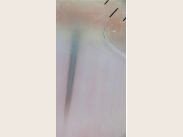 Nævus confirmé en histologie : bande étroite gris-bleu, nettement plus large en haut, côté cuticule, qui s'effile vers le bas en direction du bord libre.