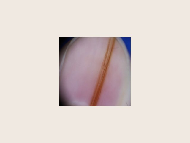 Bande brune étroite qui traverse l'ongle en oblique ; ses fines lignes parallèles gardent la même teinte, la même épaisseur et le même écart d'un bout à l'autre.