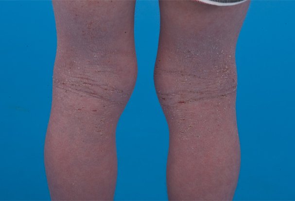 Dermatite atopique : creux poplités secs, épaissis et excoriés.
