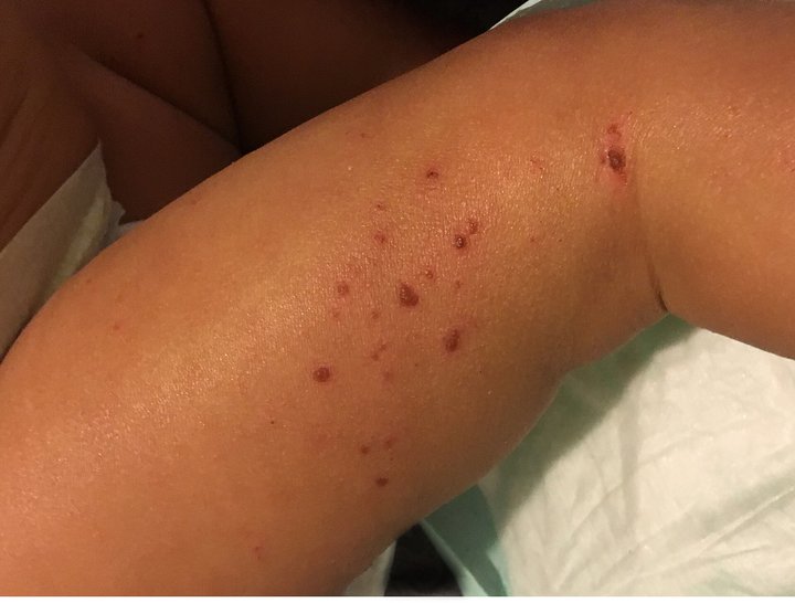 Dermatite atopique d'un jeune enfant : peau sèche et excoriations du bras.