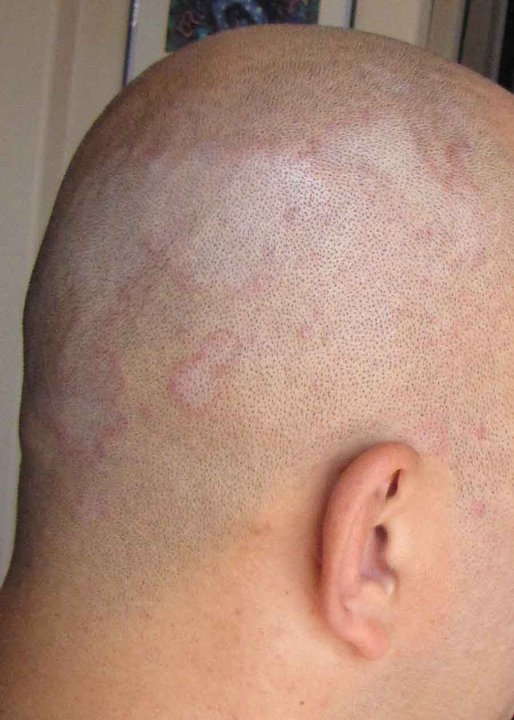 Dermatite séborrhéique du cuir chevelu rasé : plaques rosées finement squameuses, vue de dos et de profil.