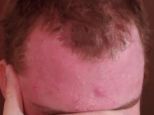 Dermatite séborrhéique du front et de la lisière du cuir chevelu : rougeur et squames grasses, yeux cachés par la main.