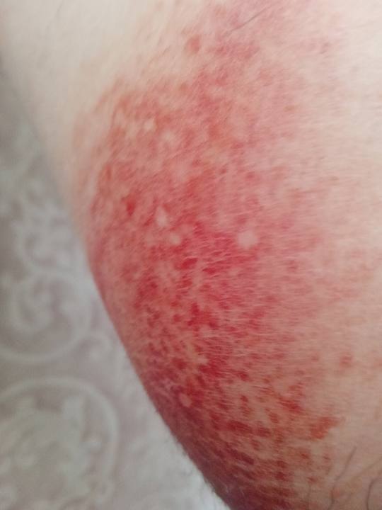Intertrigo candidosique probable : nappe rouge vif à bords émiettés avec petites lésions satellites, dans un pli de la cuisse.