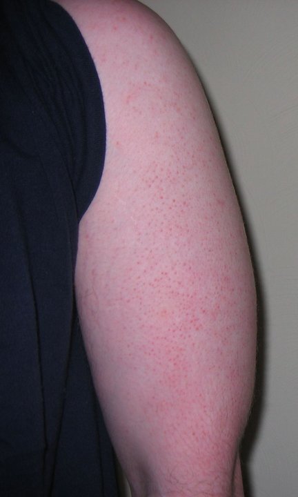 Kératose pilaire de la face postérieure du bras : petites papules folliculaires rosées.