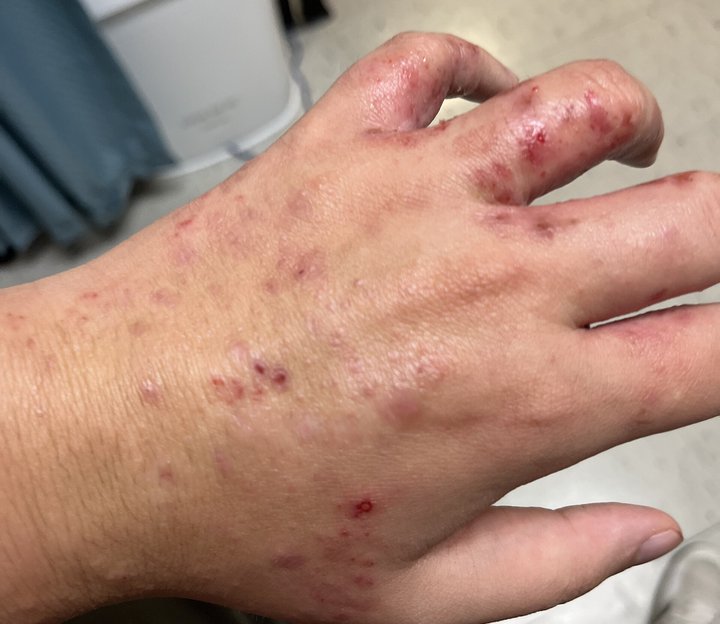 Eczéma dyshidrosique de la main : vésicules, papules excoriées et croûtes des doigts et du dos de la main.