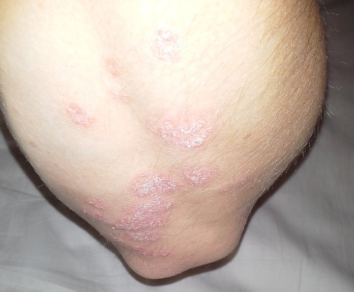 Psoriasis du coude : plaques rosées bien limitées couvertes de squames blanches, gros plan.