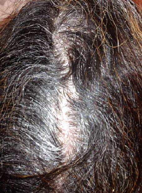 Psoriasis du cuir chevelu : squames blanches épaisses le long de la raie, cheveux foncés.