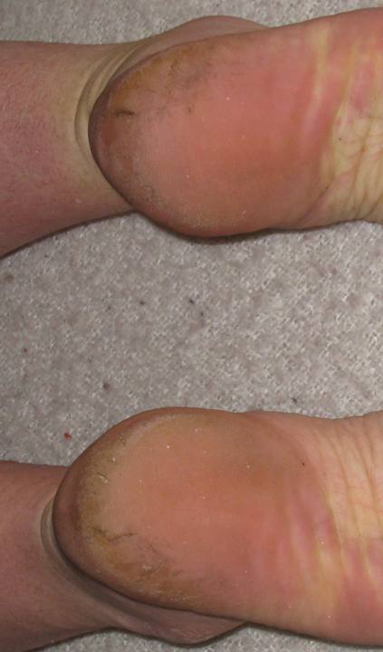 Talons fissurés : hyperkératose jaunâtre du pourtour des talons avec crevasses (rhagades).