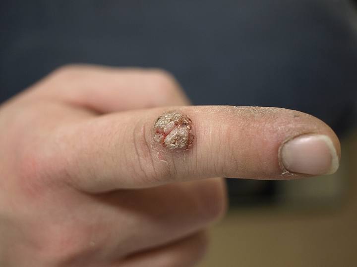 Verrue vulgaire : papule kératosique bourgeonnante de la face dorsale d'un doigt.